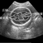 左侧侧脑室增宽是什么原因导致的,胎儿侧脑室增宽原因是什么