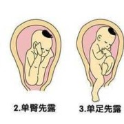 胎位几个月的时候定型啊，是不是八个月就改不了了,胎儿的胎位几个月定型了