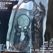 胎儿核磁共振多少钱（八个月宝宝能做核磁共振吗）