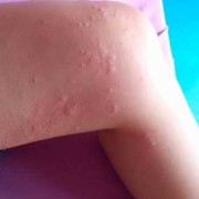 孕期得荨麻疹怎么办（孕妇反复得荨麻疹要怎么治疗）