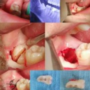 备孕期间可以拔智齿吗,怀孕期间能拔智齿吗用麻醉药品吗