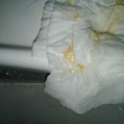 孕期流粘液（孕妇流粘液）