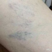 孕期外阴静脉曲张症状