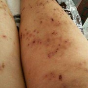 孕妇胆淤最晚什么时候生产？有哪些需要注意的事情,哪些孕妇容易得胆淤症