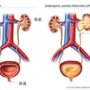 胎儿双肾积水怎么回事（双肾积水怎么治）