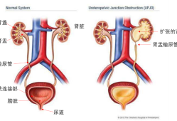 胎儿双肾积水怎么回事（双肾积水怎么治）