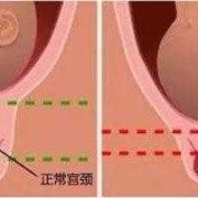孕14周多宫颈管长度27mm正常吗,孕期宫颈管长度多少正常范围