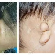 宝宝耳朵轮廓不适特别圆滑是怎么回事,胎儿耳廓图片