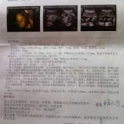 四维彩超查出宝宝肾有积水怎么办,怎么能减轻胎儿肾积水的发生
