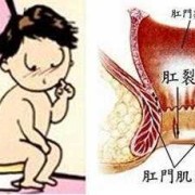 孕期便秘肛裂（孕期便秘肛裂怎么办）