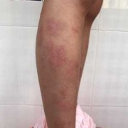 孕妇得了皮炎怎么办，能用药吗,孕妇皮炎影响胎儿吗知乎
