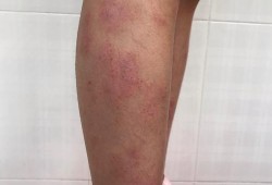 孕妇得了皮炎怎么办，能用药吗,孕妇皮炎影响胎儿吗知乎