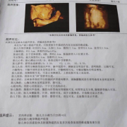 怀孕4个月，B超检查胎儿只有一个肾,胎儿肾正常值