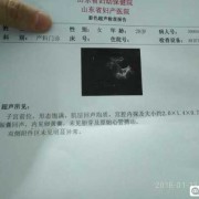 胎儿没有心管搏动（胎儿没有心管搏动）