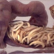 寄生虫对胎儿的影响（小孩长蛔虫的症状有哪些）