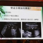 胎儿双肾分离（胎儿双肾分离是怎么回事）