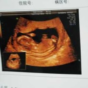 15周胎儿清晰大图（15周胎儿清晰大图男女）