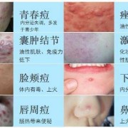 孕期痤疮怎么治疗方法（孕期痤疮怎么治疗方法）
