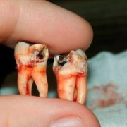 怀孕期间可以拔牙吗（怀孕初期拔掉了一颗大牙怎么办）