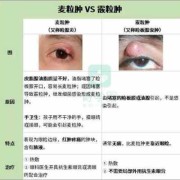 孕期麦粒肿（孕妇长麦粒肿怎么办）