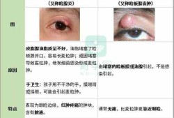 孕期麦粒肿（孕妇长麦粒肿怎么办）
