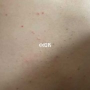 孕妇得湿疹怎么办,孕期出现湿疹怎么办啊