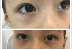 8个月宝宝黑眼圈是怎麽回事,8个月胎儿样子图片