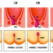 孕期痔疮很大脱出很疼（孕期痔疮很大脱出很疼怎么办）
