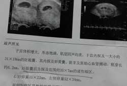 胎儿性暗区（胎儿腹部暗区）