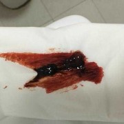 孕期四十天出血（有没有怀孕40天出血像月经一样的）