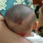 胎儿头扁小（胎儿头扁小）