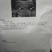 胎儿肠管扩张正常范围,四维彩超胎儿趴着不动怎么办