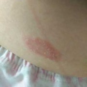怀孕期间长藓怎么办（怀孕期间长癣怎么办）