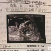 胎儿鼻骨可见（做NT胎儿鼻骨显示不清）