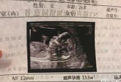 胎儿鼻骨可见（做NT胎儿鼻骨显示不清）