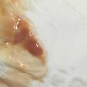 怀孕中期白带有血丝,孕期中期出血正常吗