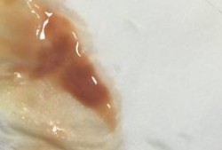怀孕中期白带有血丝,孕期中期出血正常吗