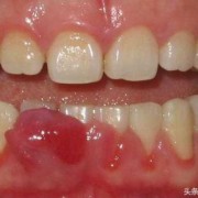 孕期牙根发炎（孕期牙根发炎要痛几天）