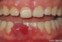 孕期牙根发炎（孕期牙根发炎要痛几天）