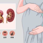 孕期肾结石症状（孕期肾结石症状表现）