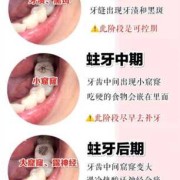孕妇龋齿很严重咋办,孕期龋齿疼的厉害怎么办