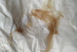 孕期胸涨（孕妇胸涨小腹疼褐色白带的原因是什么）