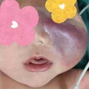 宝宝在宫内挤压左脸变形会好吗,胎儿头挤变形