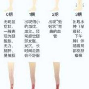 孕期静脉曲张怎么治疗（怀孕后外阴静脉曲张该怎么缓解）