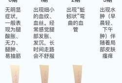 孕期静脉曲张怎么治疗（怀孕后外阴静脉曲张该怎么缓解）