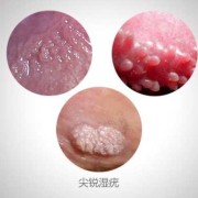 假性湿疣是什么病,孕期假性尖锐疣很痒怎么办