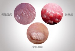 假性湿疣是什么病,孕期假性尖锐疣很痒怎么办