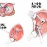 胎儿主动脉偏细吃什么（胎儿主动脉偏细吃什么长得快）