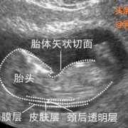 胎儿仰头（胎儿仰头对nt影响）