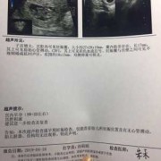 宫腔积液对胎儿的影响（宫腔积液对胎儿的影响过了三个月会减小吗）